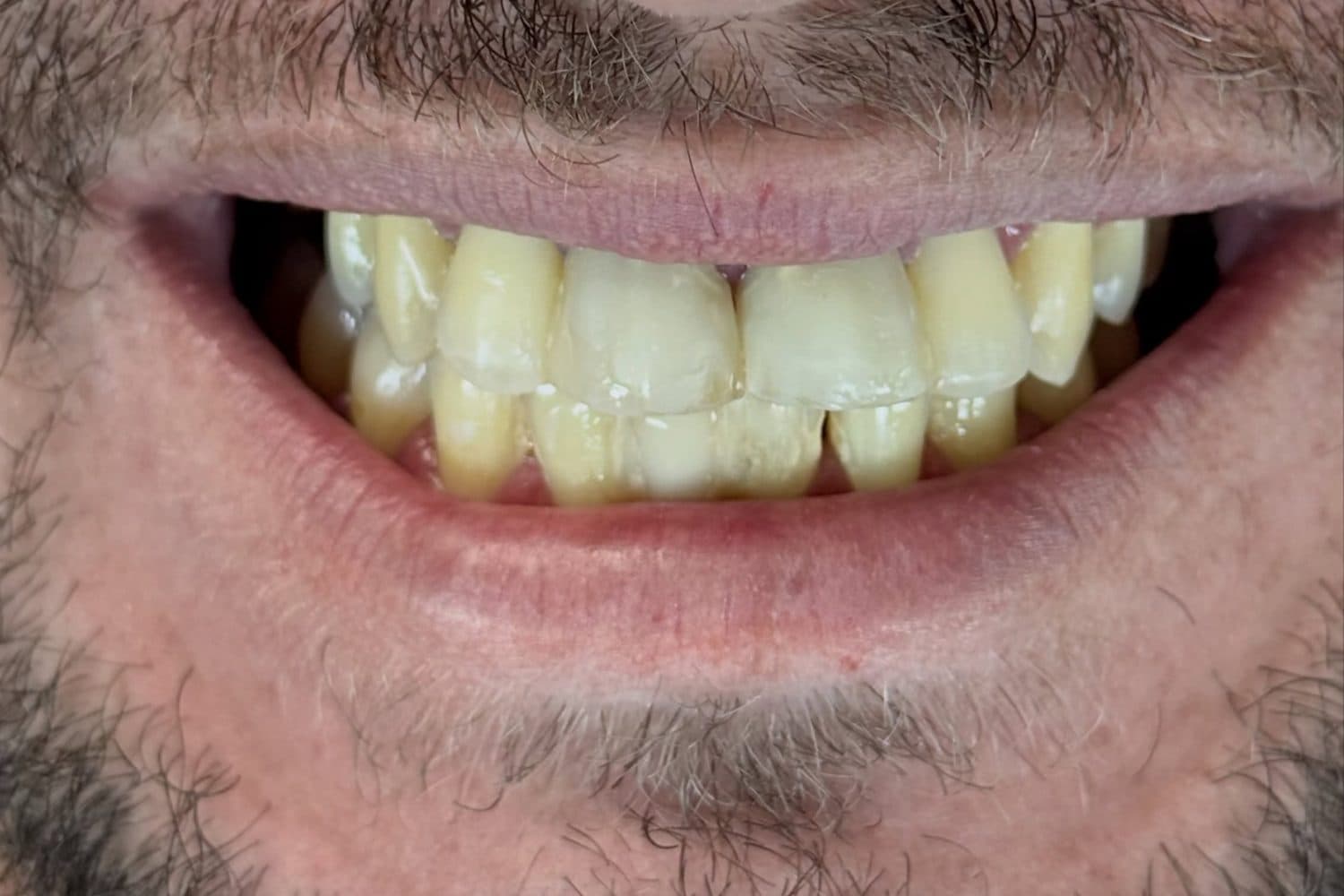 Antes: sorriso de um homem de barba, com os dentes amarelados e desalinhados