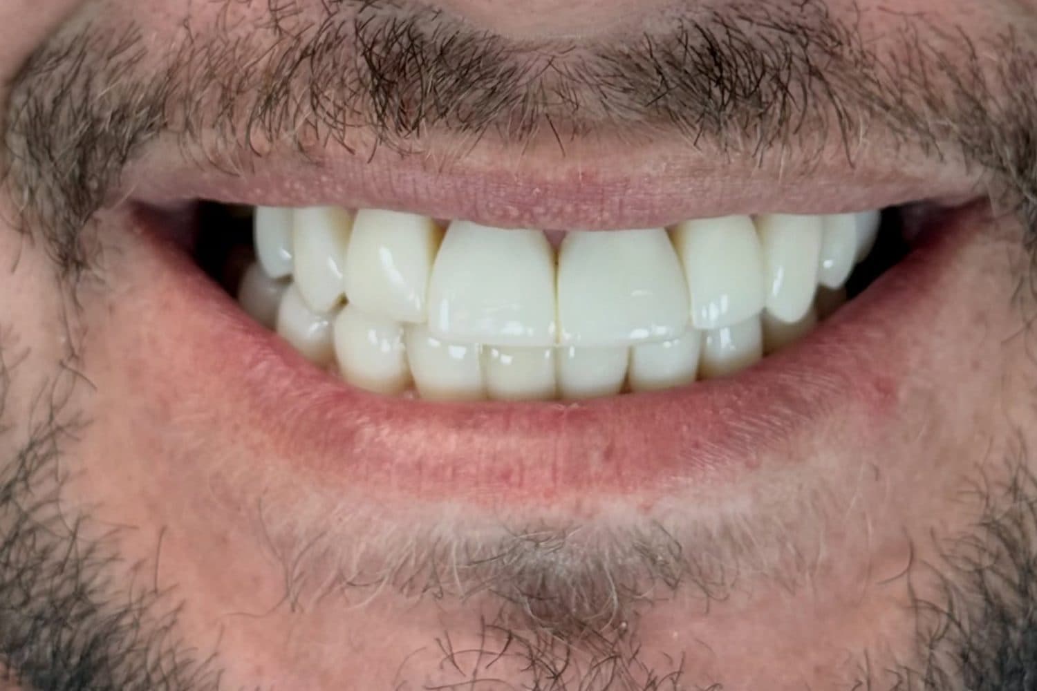 Depois: sorriso de um homem de barba, com os dentes amarelados e desalinhados, já tratado