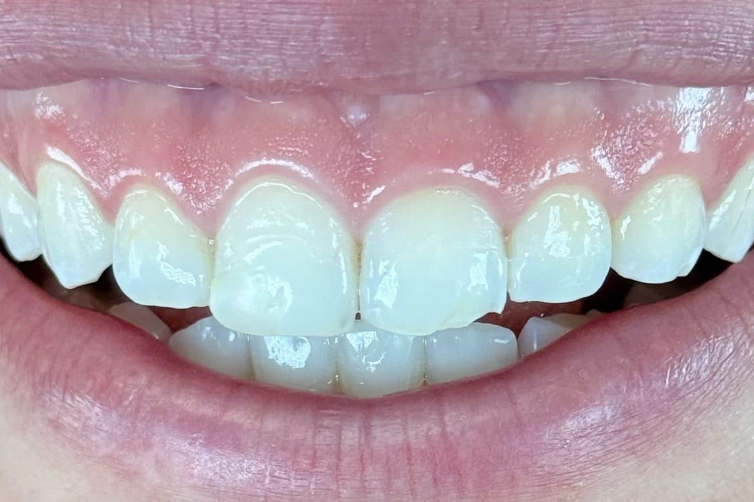 Antes: sorriso de uma mulher com a gengiva aparecendo bastante e os dentes curtos