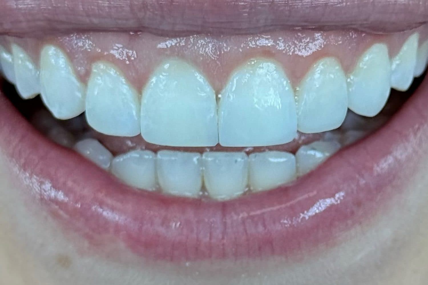 Depois: sorriso de uma mulher com a gengiva aparecendo bastante e os dentes curtos, já tratado